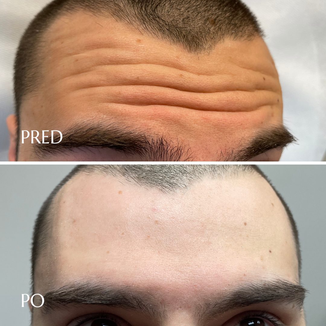 Diskrétna ukážka — pred a po preventívnej aplikácii botulotoxínu do čela